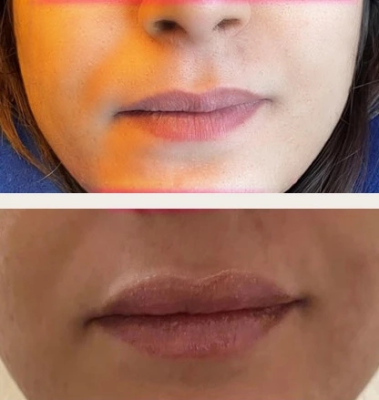 What Are Lip Fillers and How Do They Work in Alexandria, VA?